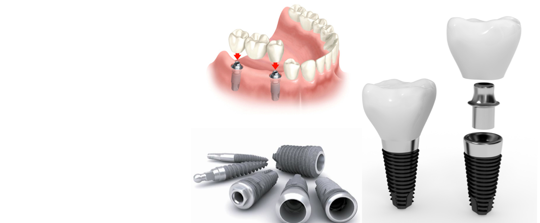 Dentální implantáty — komponenty